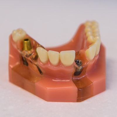 Dental Implants San Francisco - Photo to show fixed bridges can be achieved with dental implants