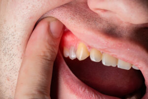 Man with swollen gum around one tooth