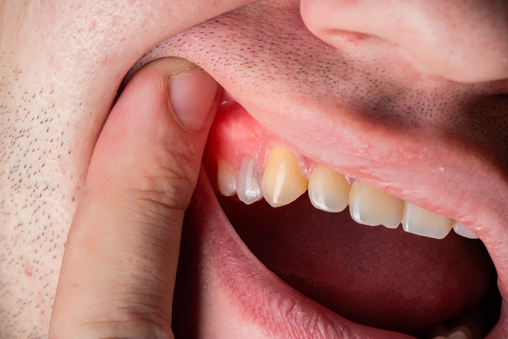 Swollen Gum Tissue Around a Tooth? We Can Help!